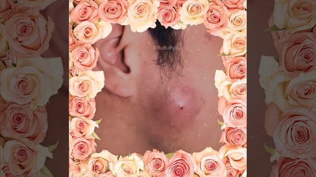 Гнойник на лице смотреть онлайн