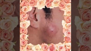 Гнойник на лице