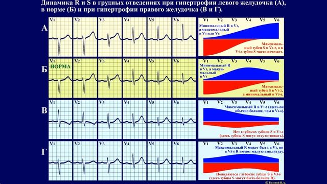 Тема 23.2. ЭКГ при гипертрофии камер сердца. смотреть онлайн