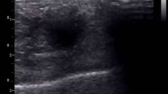 Неврома Мортона смотреть онлайн