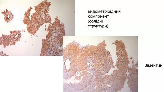 Клінічний кейс з онкогінекології: змішана карцинома ендометрія смотреть онлайн