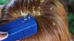 HUGE OILY psoriasis FLAKES! Scalp scratching for great relax Big Flake