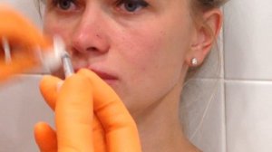 БОТУЛОТОКСИН при ярко выраженных НОСОГУБНЫХ СКЛАДКАХ и Уменьшения объема НОСА.