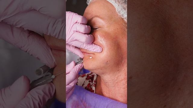 Коррекция губоподбородочных складок с применением мезонитей Screw/Пружинка смотреть онлайн