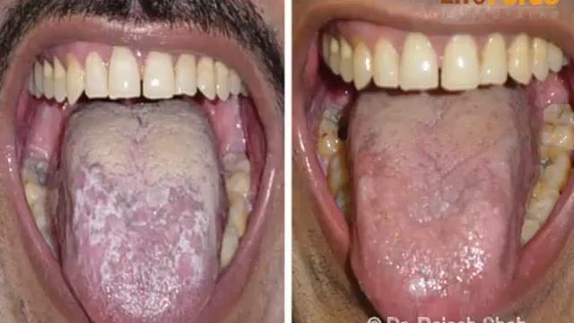 Lichen Planus awareness series- A case of Oral Lichen Planus treated at Life Force смотреть онлайн