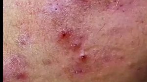 чёрные точки на носу прыщи на лице