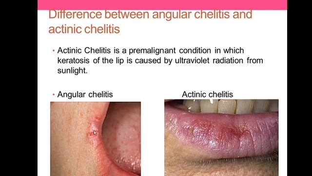 34-Predisposing factors of angular chelitis and treatment(MJDF) смотреть онлайн