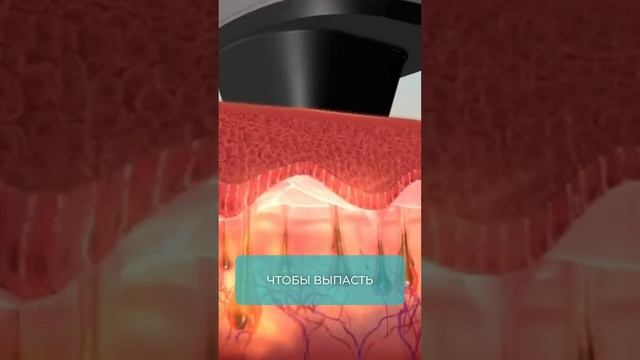 Почему остаются ЧЕРНЫЕ ТОЧКИ после ЛАЗЕРНОЙ ЭПИЛЯЦИИ? #эпиляция #черныеточки #лазернаяэпиляция