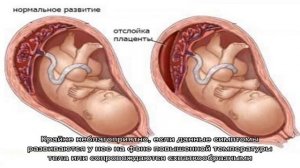 Почему при беременности могут появиться сгустки крови?