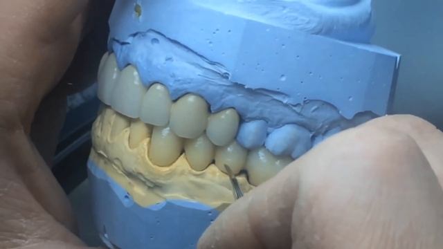 Металлокерамические мостовидные протезы смотреть онлайн