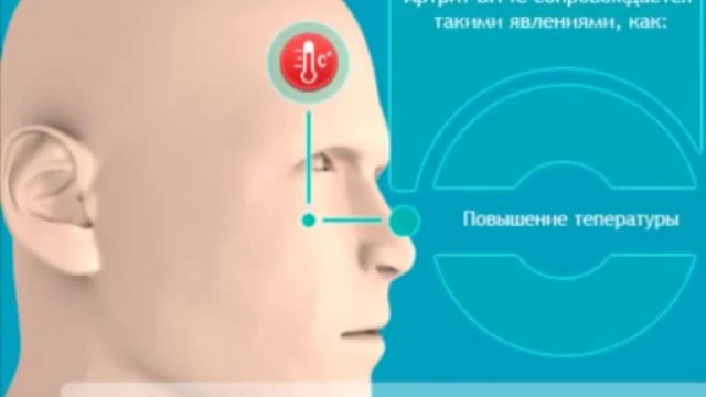 Артрит ВНЧС