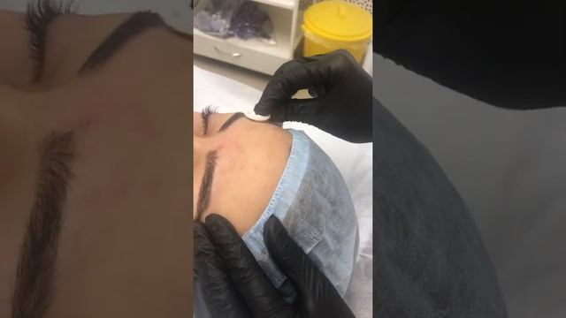 Пилинг Джесснера смотреть онлайн