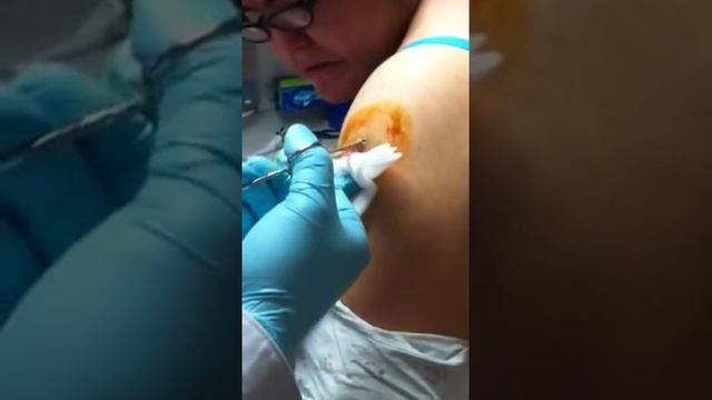 Popping the bug bite! смотреть онлайн