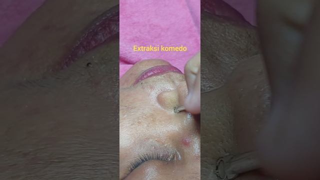 ❤️ Tutorial Facial Chemical Peeling