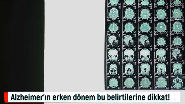 Alzheimer’ın erken dönem belirtilerine dikkat! Alzheimer başlangıcı nasıl anlaşılır? смотреть онлайн