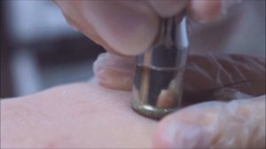 Вакуумная чистка лица / Дермабразия / Пилинг кожи лица