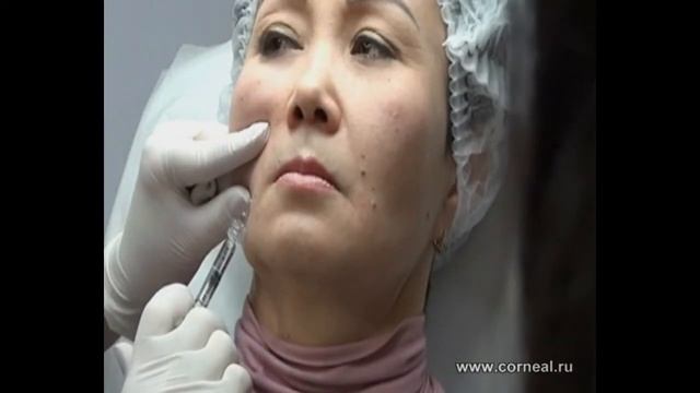 Канюли, это совершенно другой уровень смотреть онлайн