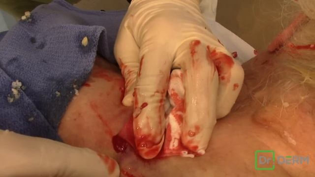 EXPLOSIVE Idaho Potato Cyst!! | Dr. Derm