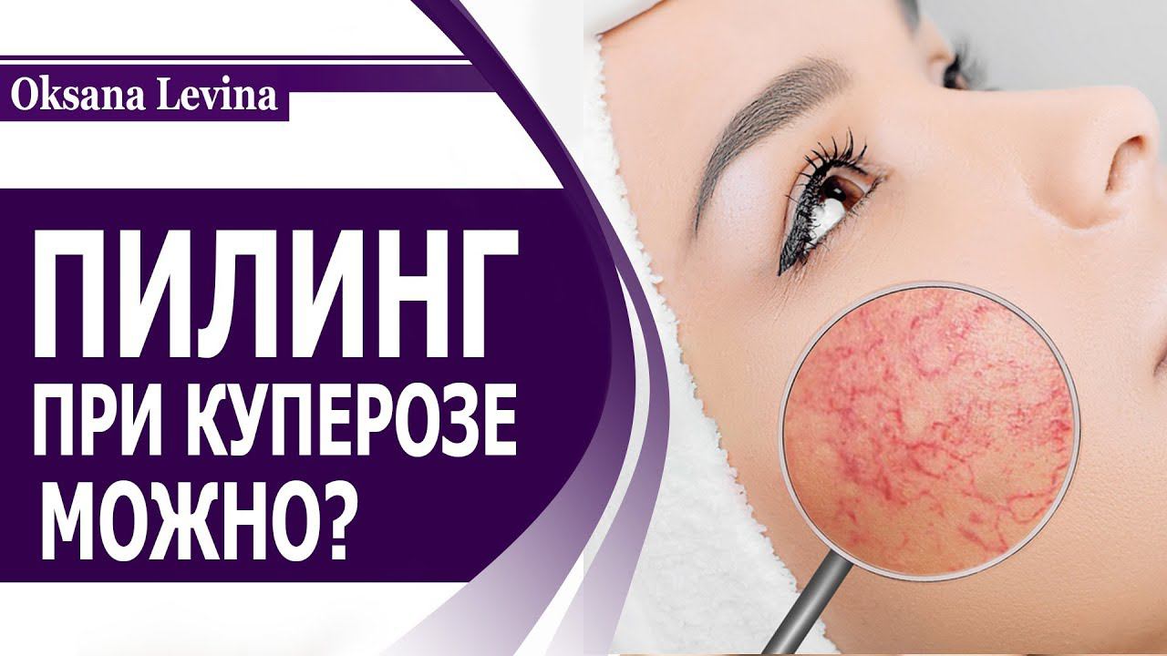 КУПЕРОЗ. КАКОЙ ПИЛИНГ МОЖНО ДЕЛАТЬ ПРИ КУПЕРОЗЕ И РОЗАЦЕА смотреть онлайн
