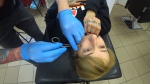 Удаление микродермала ( Microdermal Removal )