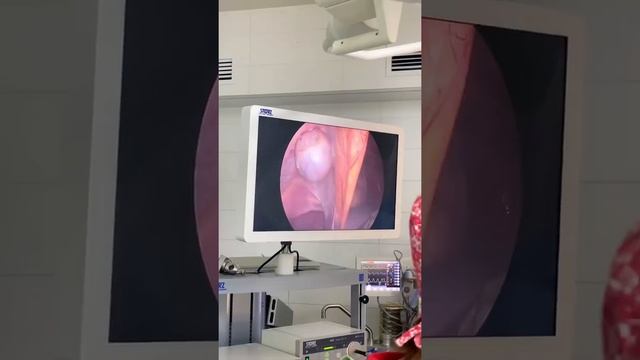 Холецистэктомия - удаление желчного пузыря