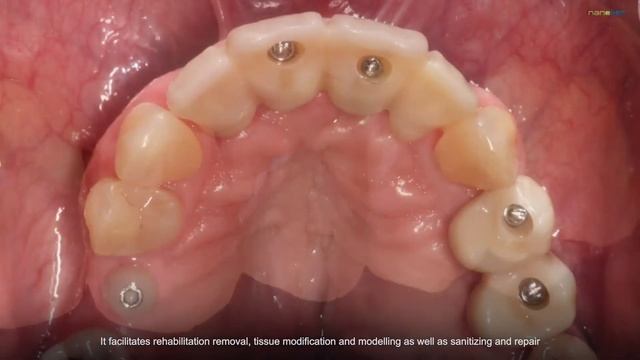 INPERIO Monoblock All Ceramic Composite Dental Implant (English with Subtitles) смотреть онлайн