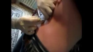 прокол пупка