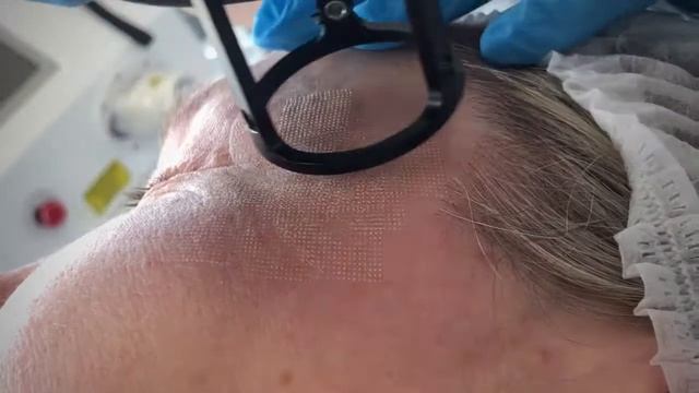 Фракционное омоложение лица. смотреть онлайн