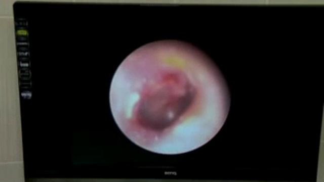 Мононуклеоз смотреть онлайн