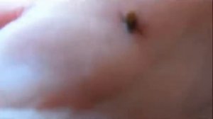 Укус клеща! Как правильно вытащить клеща.