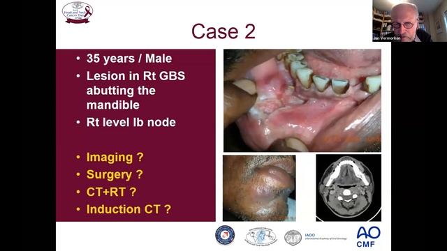 Global Oral Cancer Symposium 2020 | Advanced Oral Cancer Management: Controversies To Consensus