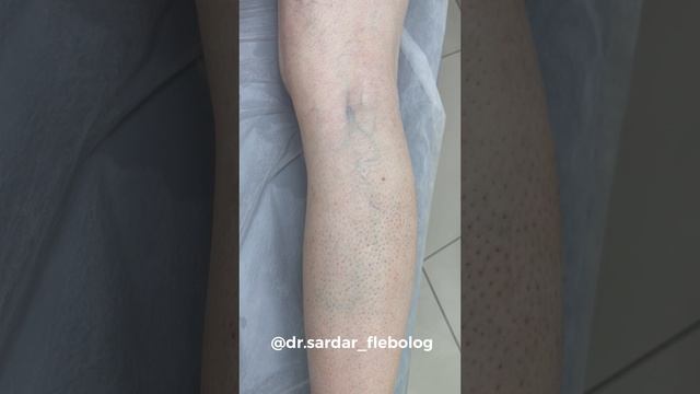 У парня процедура склеротерапии. Лечение варикоза уколом без операции. Флеболог Москва. Флеболог смотреть онлайн