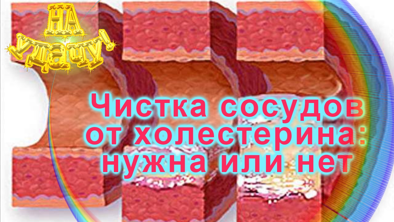 Чистка сосудов от холестерина нужна или нет