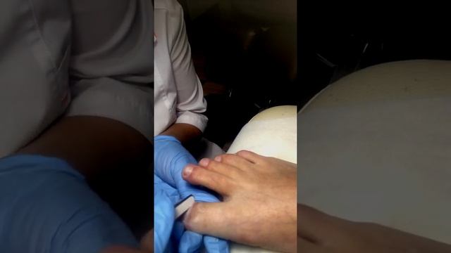 Установка коррекционной системы на вросший ноготь смотреть онлайн