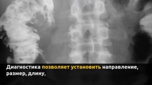 Фистулография