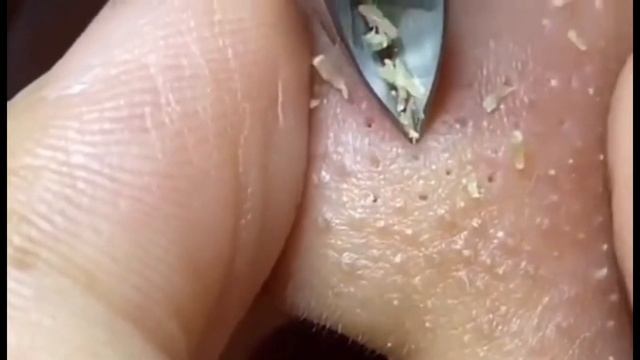 Выдавливание мерзких чёрных точек угри ПРЫЩИ  / BLACKHEADS