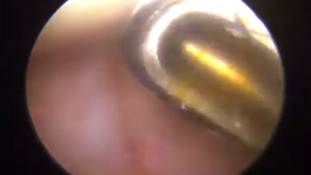 Прижигание мениска