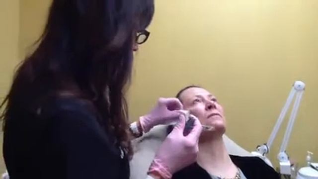 Mid-face Augmentation With Juvederm Ultra Plus