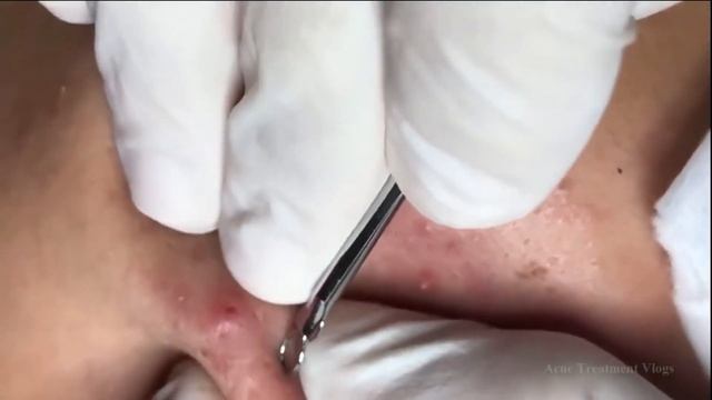 ВЫЖИМАЕМ ИЗ ЛИЦА УГРИ ЧЕРНЫЕ ТОЧКИ