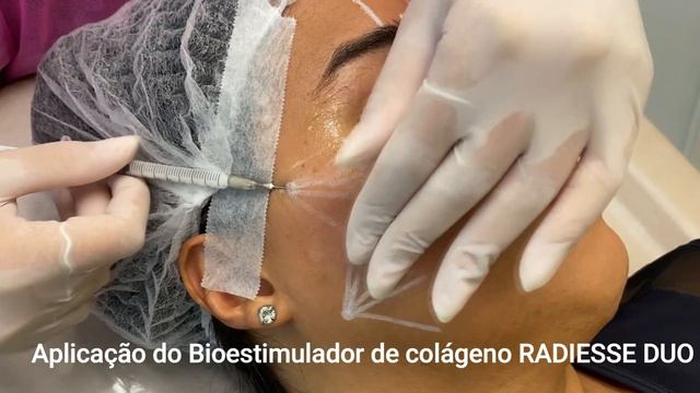 RADIESSE - FIZ ESSE PROCEDIMENTO NO MEU ROSTO смотреть онлайн