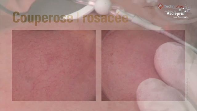 QuadroStar® d'ASCLEPION смотреть онлайн