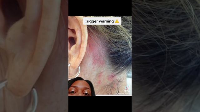CHEMICAL BURNS! Protect yourself when using hair lightener! смотреть онлайн