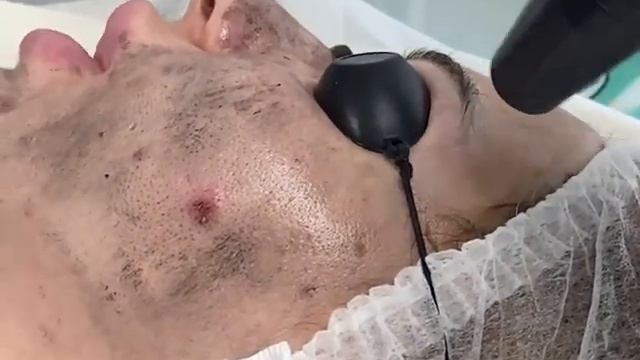 Карбоновий пілінг обличчя смотреть онлайн