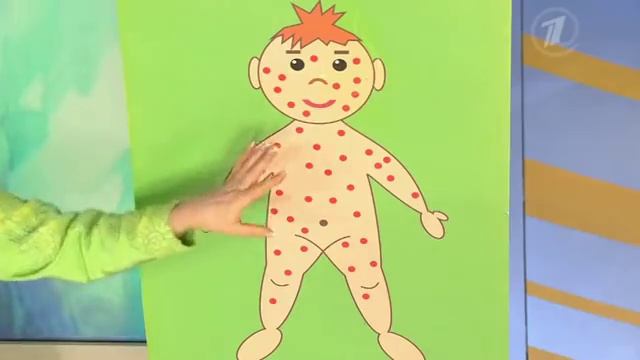 Ветряная оспа. Чем опасна ветрянка смотреть онлайн