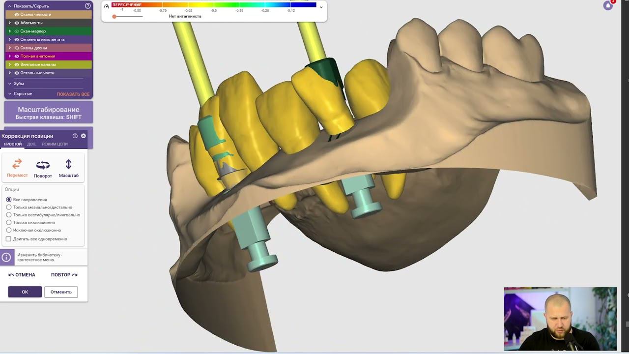 Моделировка в exocad 6 единиц с десной смотреть онлайн
