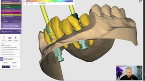 Моделировка в exocad 6 единиц с десной