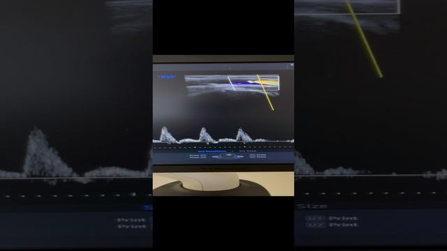 Исследование артерий. Атеросклероза нет. Сосудистый хирург Москва. Узи сосудов. Флеболог Москва смотреть онлайн