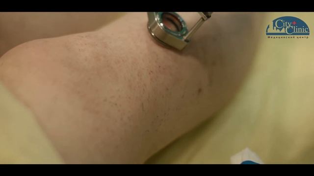 Как проходит лазерная эпиляция ног в "City Clinic" смотреть онлайн