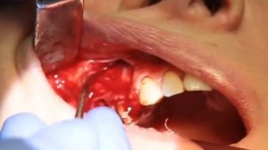 Резекция верхушек корней зубов, удаление, имплантация. Профессор Орлов