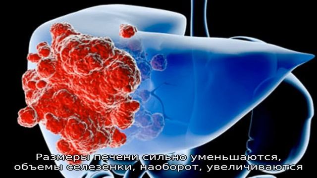 Четыре стадии цирроза печени смотреть онлайн